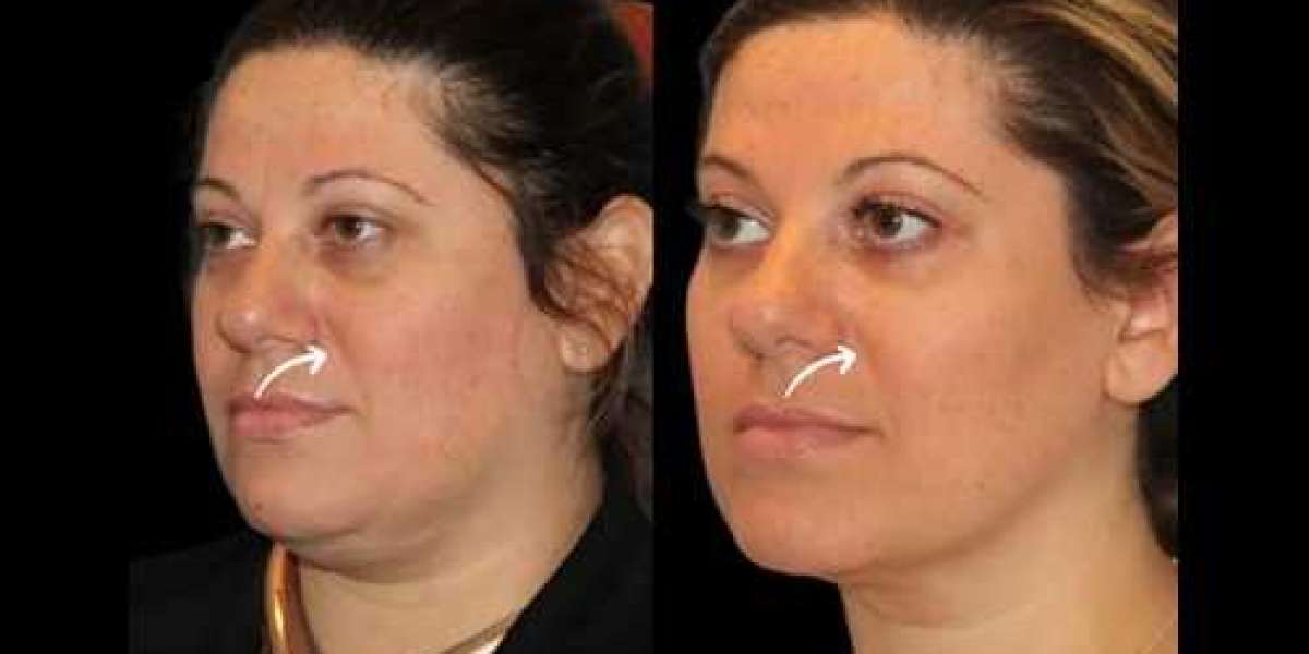 Best Plastic Surgeons in Dubai and Unique Sculptra Fillers Beauty