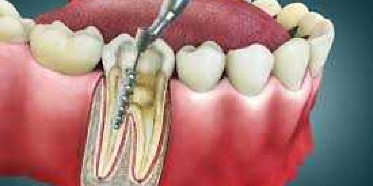أهمية علاج جذور الأسنان