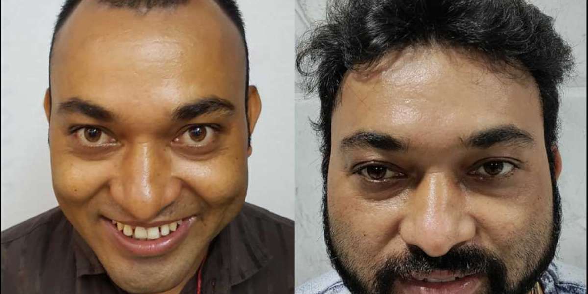 Goodbye Hair Loss, Hello New Look: Benefits of Hair Transplant in Navi Mumbai