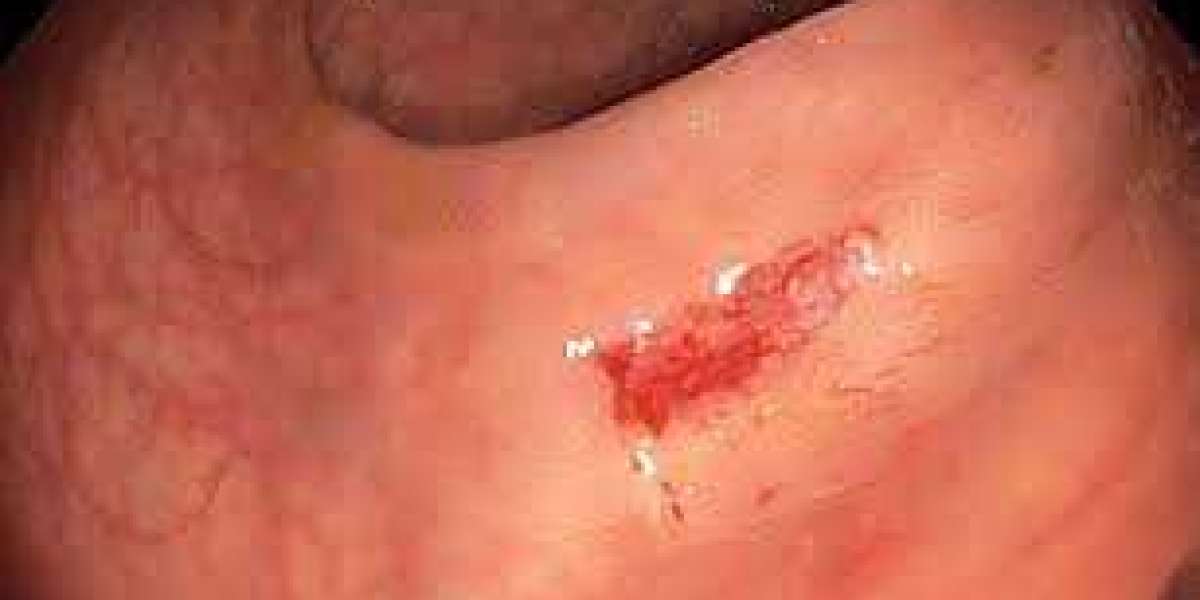 Lower GI Endoscopy in the UK: Modern Diagnosis for Digestive Health