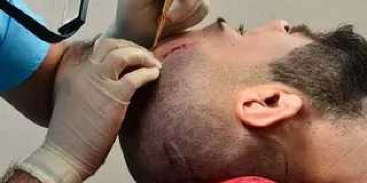 DHI Hair Transplant in Islamabad – Transform Your Look with Enfield Royal Clinic