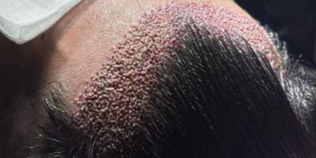 Turkey Hair Transplant Experience From Consultation to Final Results